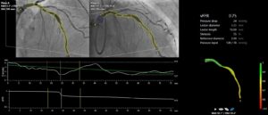 FAST-III-Studie zeigt Nicht-Unterlegenheit von CAAS vFFR gegenüber invasiver drahtbasierter FFR